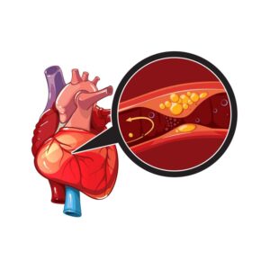 Coronary Artery Disease