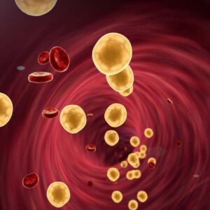 Dyslipidemia High Cholesterol