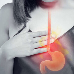 Gastroesophageal Reflux Disease