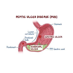 Peptic Ulcer Disease
