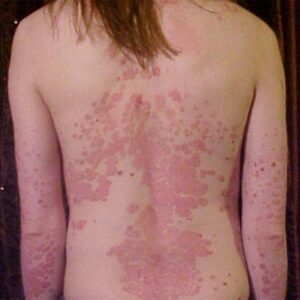 Psoriasis