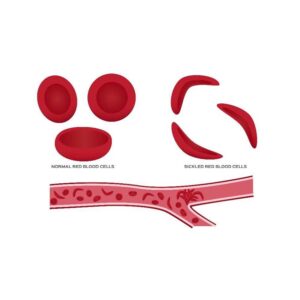 Sickle Cell Disease