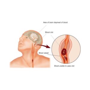 Stroke Cerebrovascular Accident